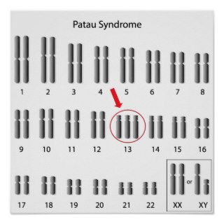 Patau syndrome, trisomy 13 Poster