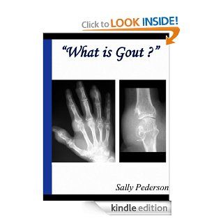 What is Gout? The Ultimate Guide To Mastering and Conquering Gout. Know the Symptoms of Gout, Causes of Gout, Treatment for Gout and more. eBook Sally Pederson Kindle Store