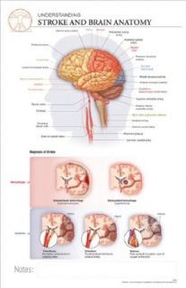 11 x 17 Post It Disease Chart STROKE & Brain Anatomy Science Lab Education Curriculum Support